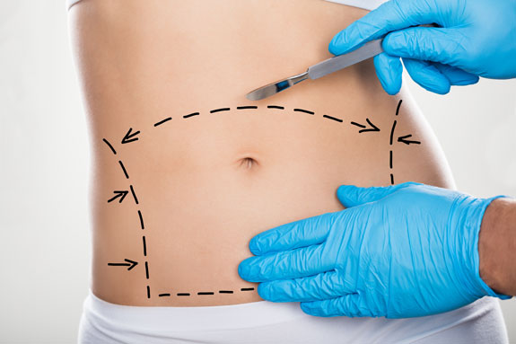 Abdominoplastik Buxtehude